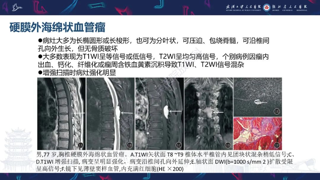 【PPT】原发性椎管内淋巴瘤影像诊断