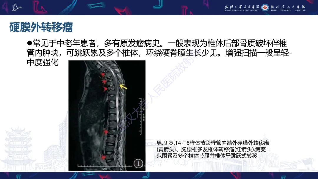 【PPT】原发性椎管内淋巴瘤影像诊断