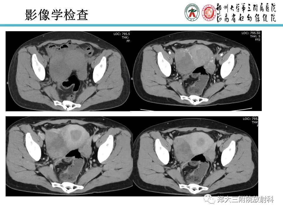 【病例】卵巢子宫内膜样癌1例MR影像诊断