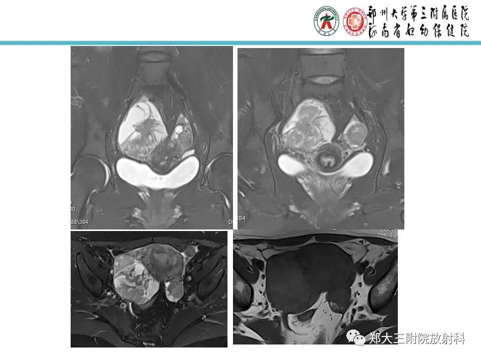 【病例】卵巢子宫内膜样癌1例MR影像诊断