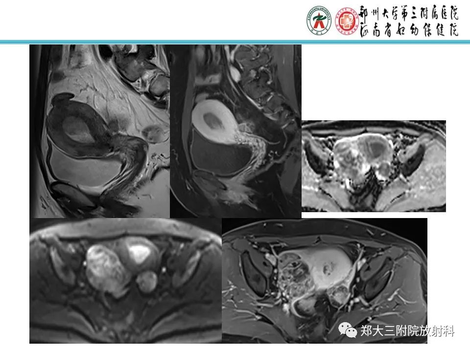 【病例】卵巢子宫内膜样癌1例MR影像诊断