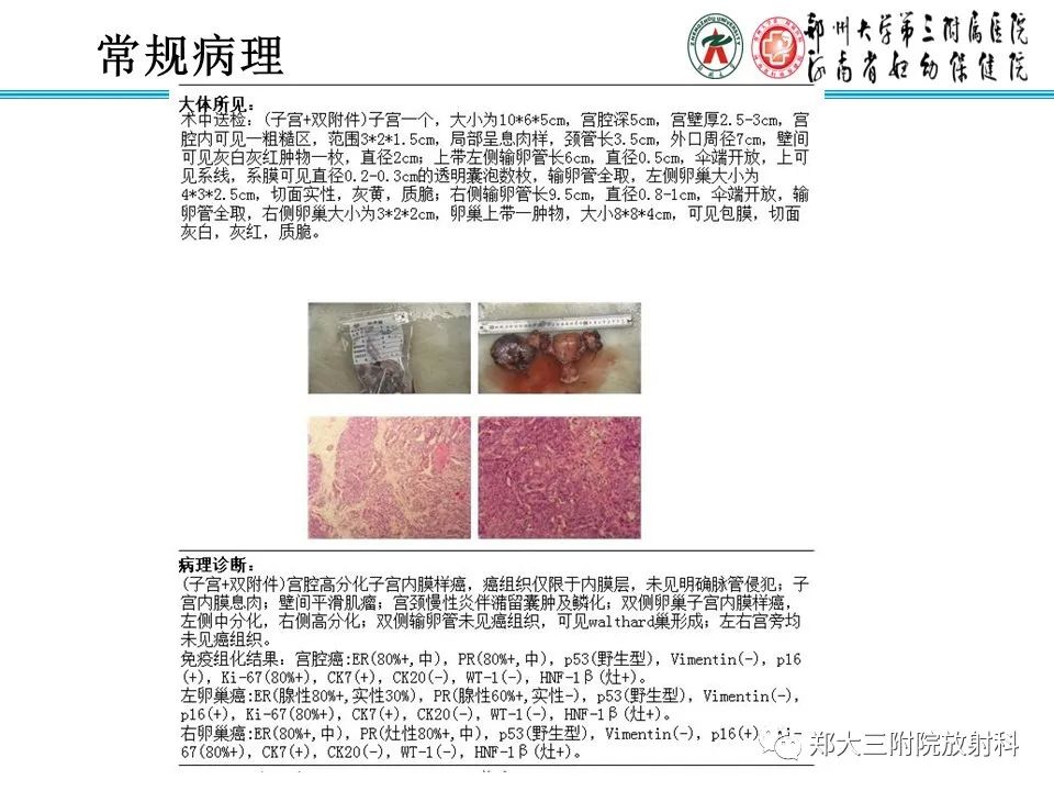 【病例】卵巢子宫内膜样癌1例MR影像诊断