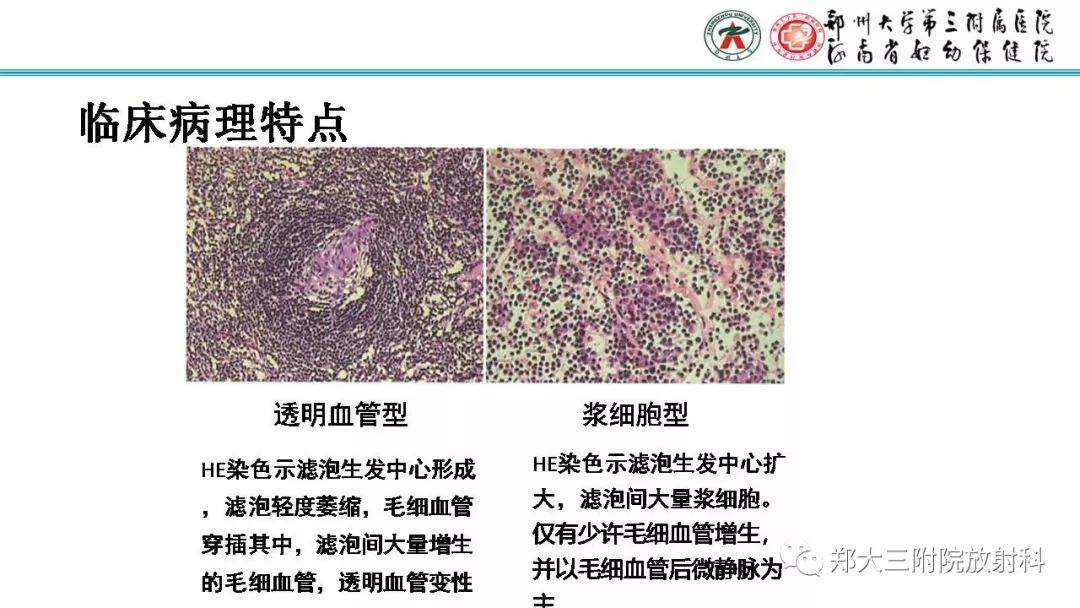 影像PPT - 【PPT】Castleman病影像诊断-5