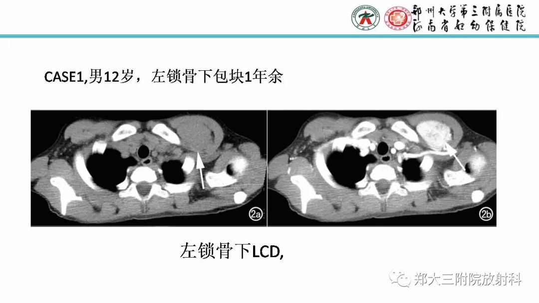 影像PPT - 【PPT】Castleman病影像诊断-15
