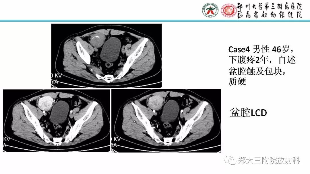 影像PPT - 【PPT】Castleman病影像诊断-18
