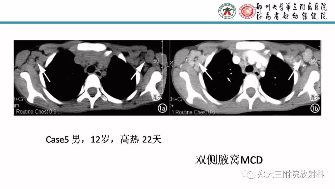 影像PPT - 【PPT】Castleman病影像诊断-19