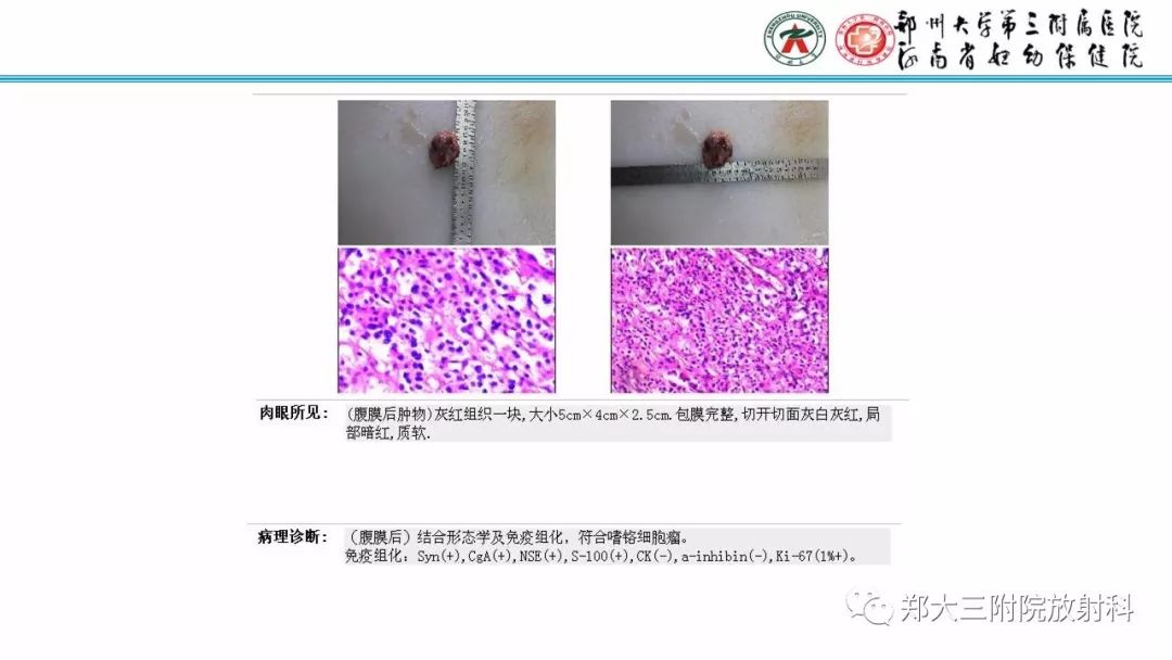 影像PPT - 【PPT】Castleman病影像诊断-22