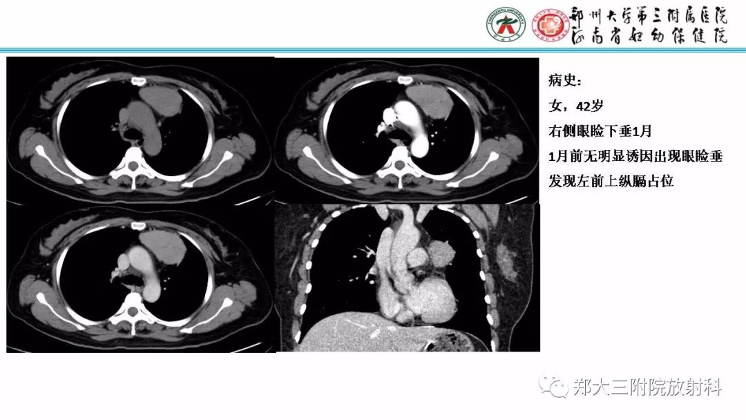 影像PPT - 【PPT】Castleman病影像诊断-24