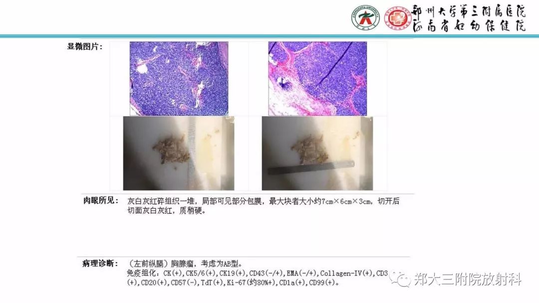 影像PPT - 【PPT】Castleman病影像诊断-25