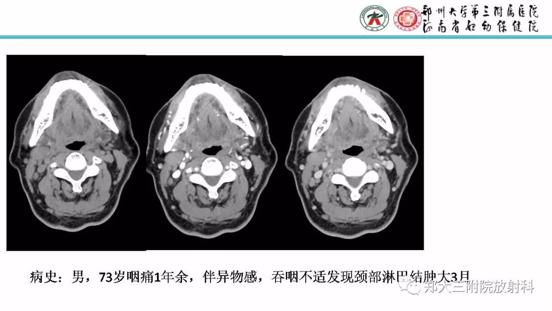 影像PPT - 【PPT】Castleman病影像诊断-27