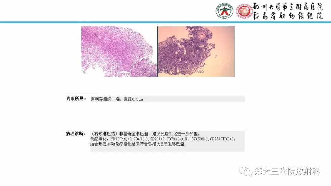 影像PPT - 【PPT】Castleman病影像诊断-28