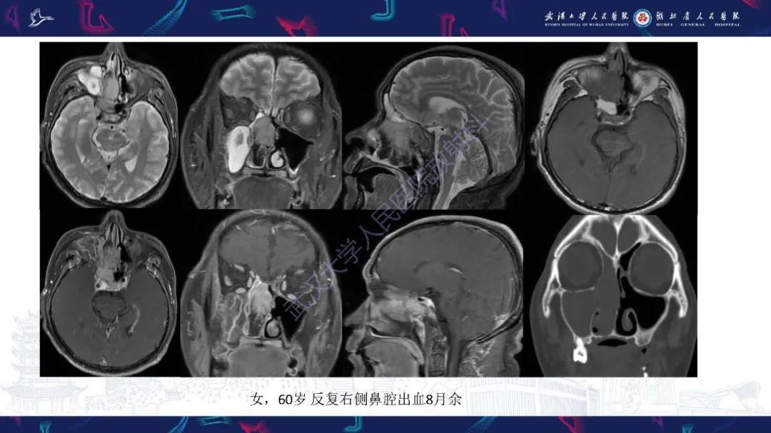 影像PPT - 【PPT】鼻腔鼻窦神经内分泌癌影像诊断及鉴别诊断-7
