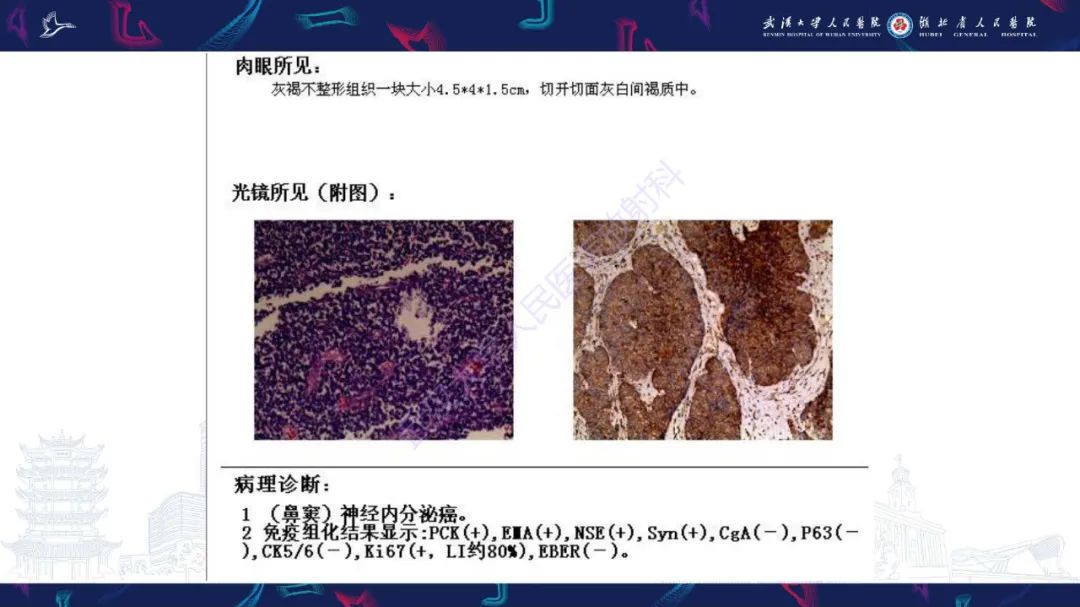 影像PPT - 【PPT】鼻腔鼻窦神经内分泌癌影像诊断及鉴别诊断-9