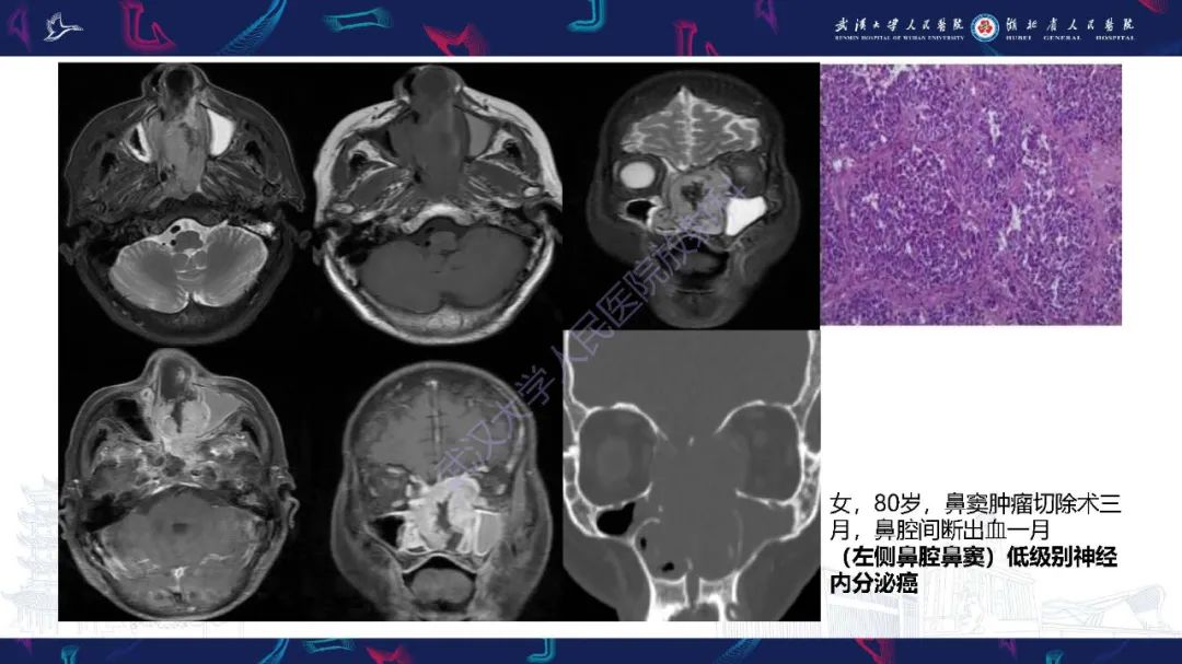 影像PPT - 【PPT】鼻腔鼻窦神经内分泌癌影像诊断及鉴别诊断-10
