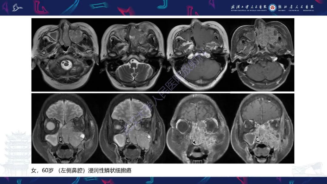 影像PPT - 【PPT】鼻腔鼻窦神经内分泌癌影像诊断及鉴别诊断-13
