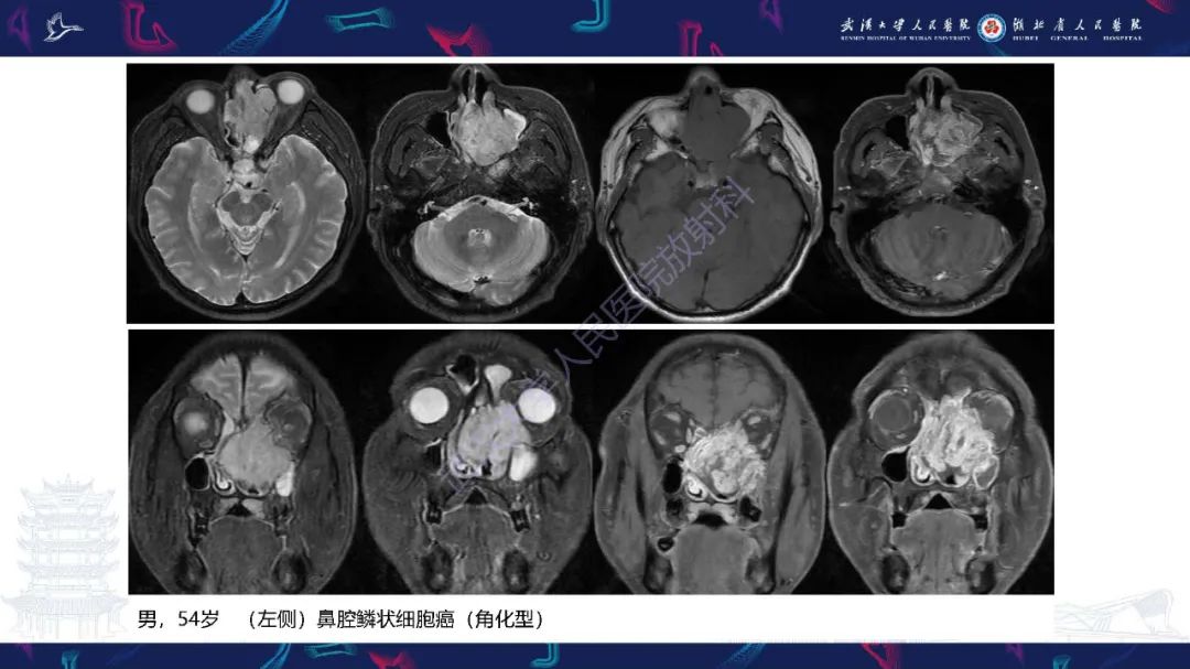 影像PPT - 【PPT】鼻腔鼻窦神经内分泌癌影像诊断及鉴别诊断-14