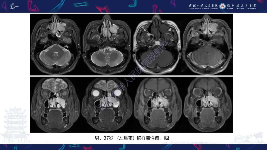 影像PPT - 【PPT】鼻腔鼻窦神经内分泌癌影像诊断及鉴别诊断-15