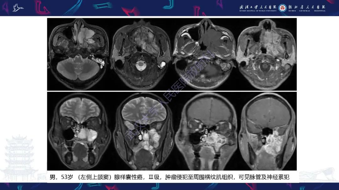 影像PPT - 【PPT】鼻腔鼻窦神经内分泌癌影像诊断及鉴别诊断-16