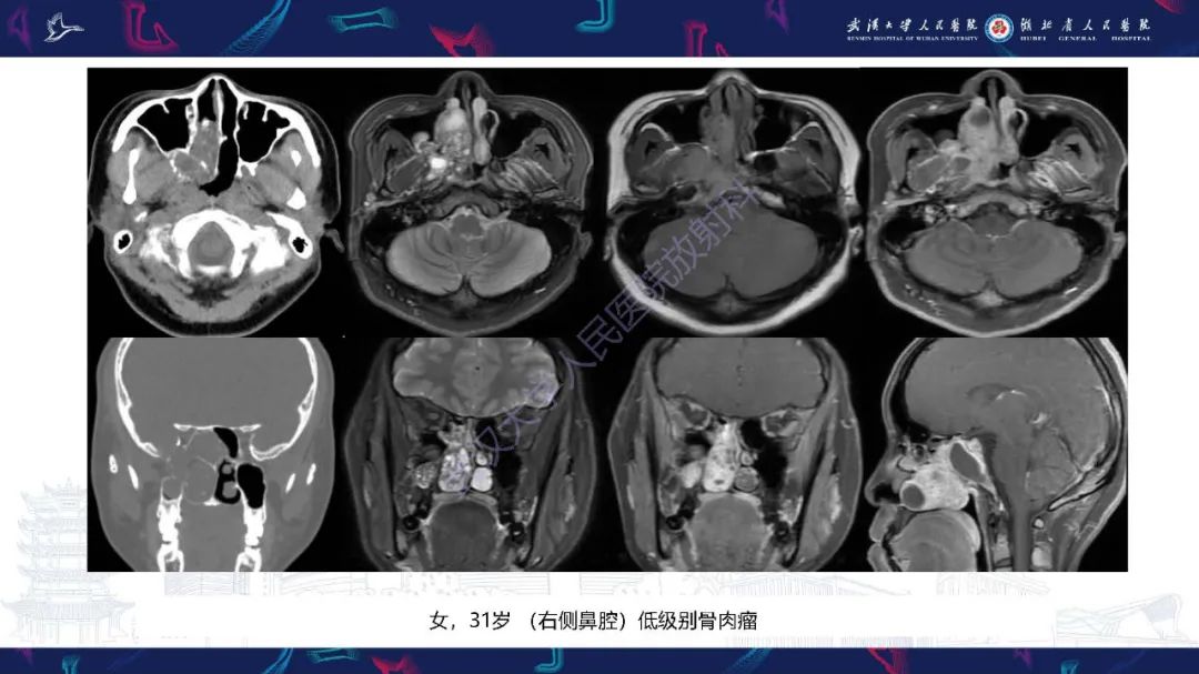 影像PPT - 【PPT】鼻腔鼻窦神经内分泌癌影像诊断及鉴别诊断-19