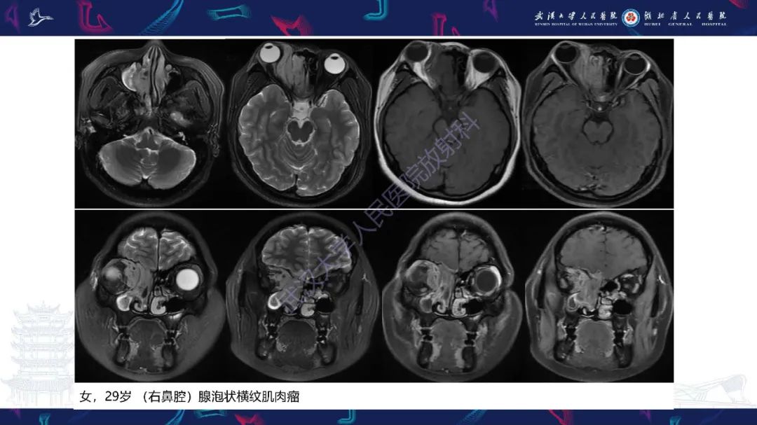 影像PPT - 【PPT】鼻腔鼻窦神经内分泌癌影像诊断及鉴别诊断-22