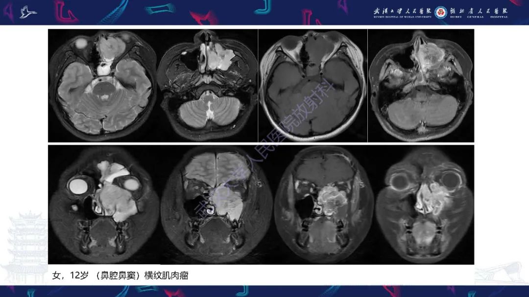 影像PPT - 【PPT】鼻腔鼻窦神经内分泌癌影像诊断及鉴别诊断-23