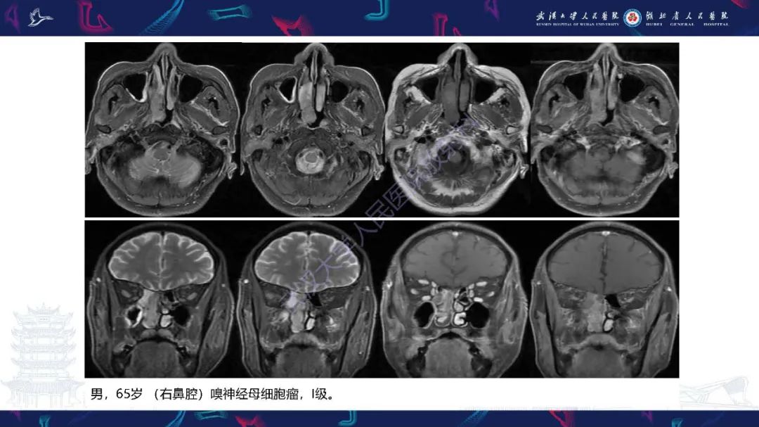 影像PPT - 【PPT】鼻腔鼻窦神经内分泌癌影像诊断及鉴别诊断-26