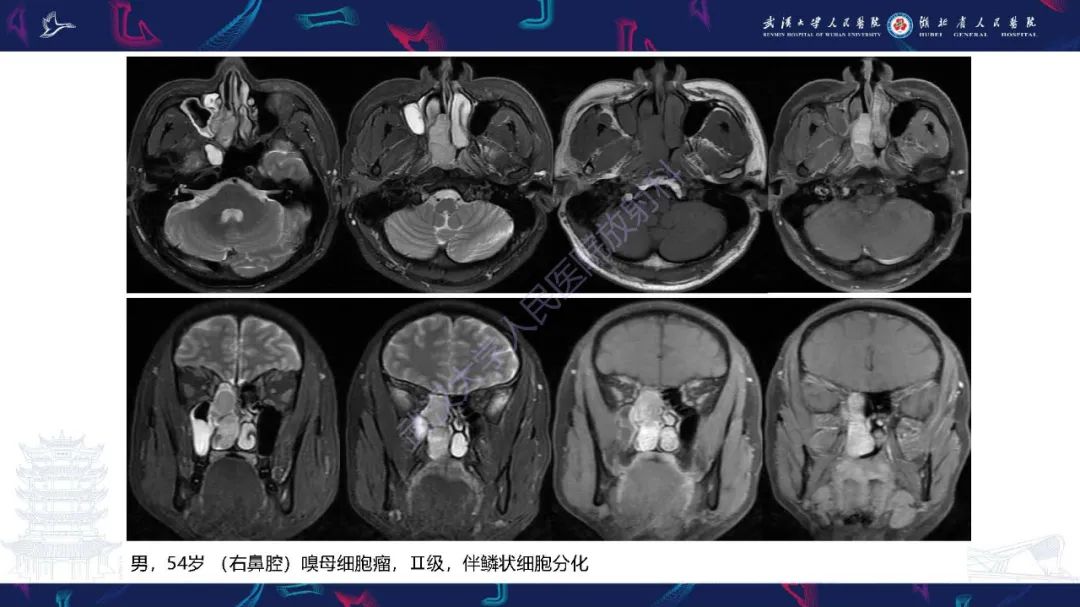 影像PPT - 【PPT】鼻腔鼻窦神经内分泌癌影像诊断及鉴别诊断-27