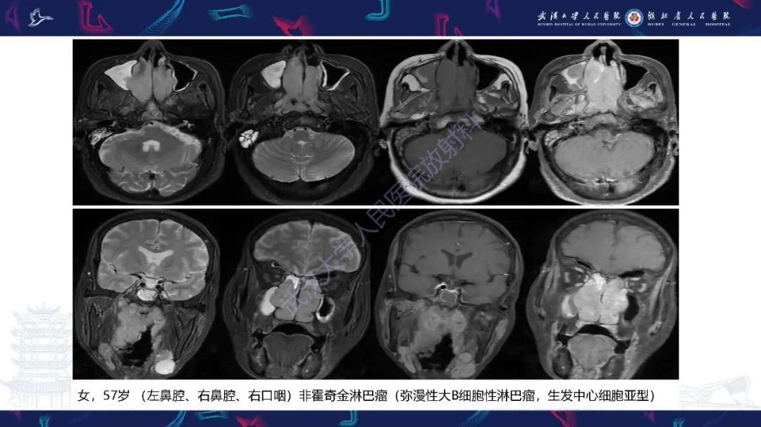 影像PPT - 【PPT】鼻腔鼻窦神经内分泌癌影像诊断及鉴别诊断-30