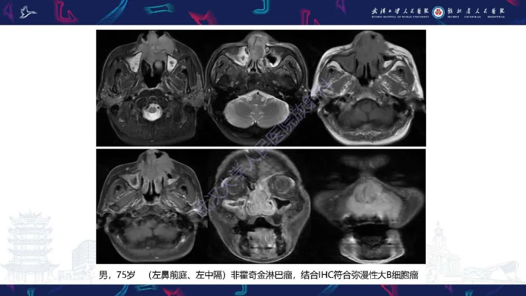 影像PPT - 【PPT】鼻腔鼻窦神经内分泌癌影像诊断及鉴别诊断-31