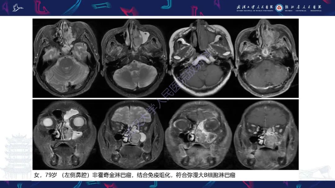 影像PPT - 【PPT】鼻腔鼻窦神经内分泌癌影像诊断及鉴别诊断-32
