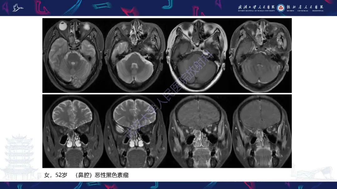 影像PPT - 【PPT】鼻腔鼻窦神经内分泌癌影像诊断及鉴别诊断-35