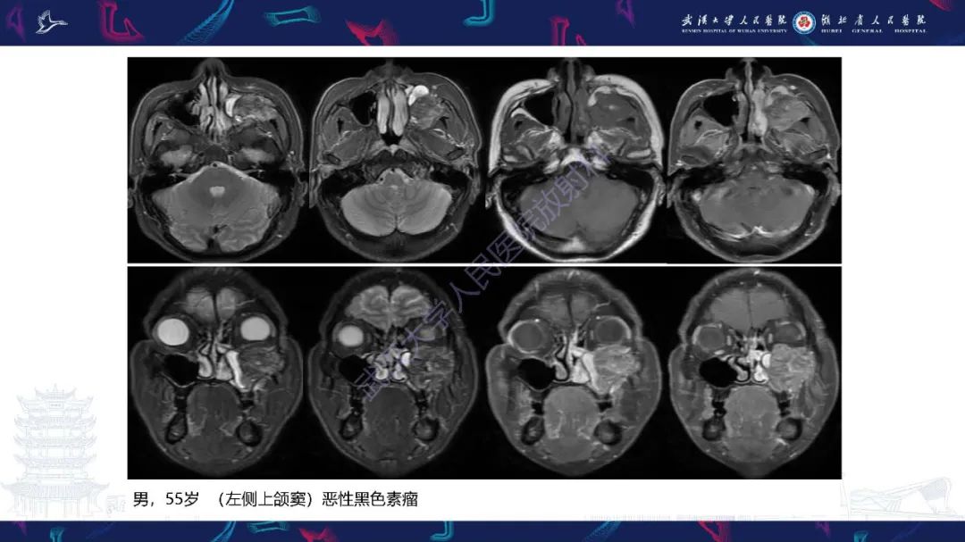 影像PPT - 【PPT】鼻腔鼻窦神经内分泌癌影像诊断及鉴别诊断-36