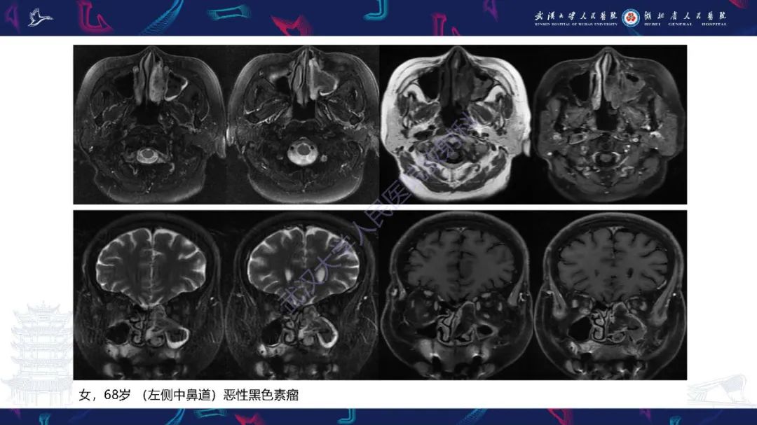 影像PPT - 【PPT】鼻腔鼻窦神经内分泌癌影像诊断及鉴别诊断-37