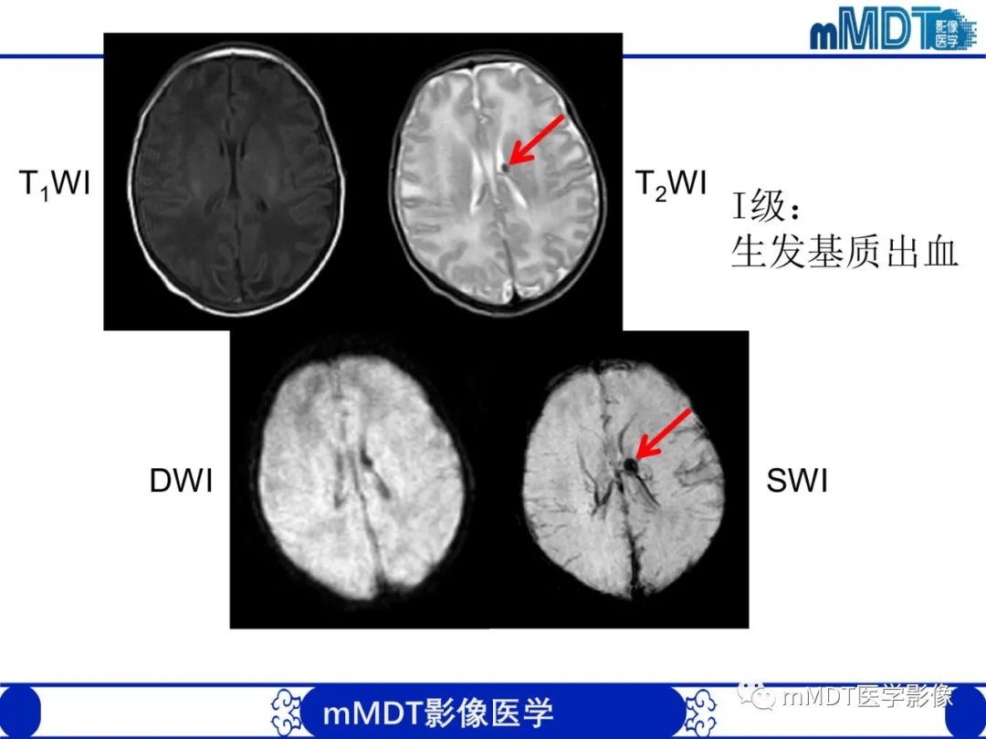 影像PPT - 【PPT】新生儿HIE影像学表现-9 影像PPT - 【PPT】新生儿HIE影像学表现-9