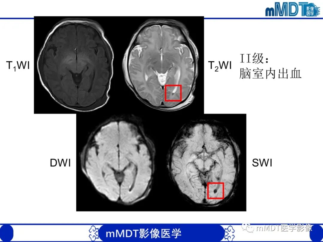 影像PPT - 【PPT】新生儿HIE影像学表现-10 影像PPT - 【PPT】新生儿HIE影像学表现-10