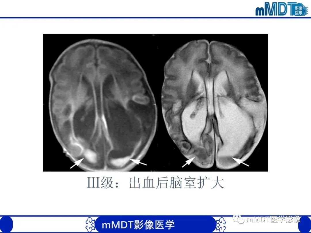 影像PPT - 【PPT】新生儿HIE影像学表现-11 影像PPT - 【PPT】新生儿HIE影像学表现-11