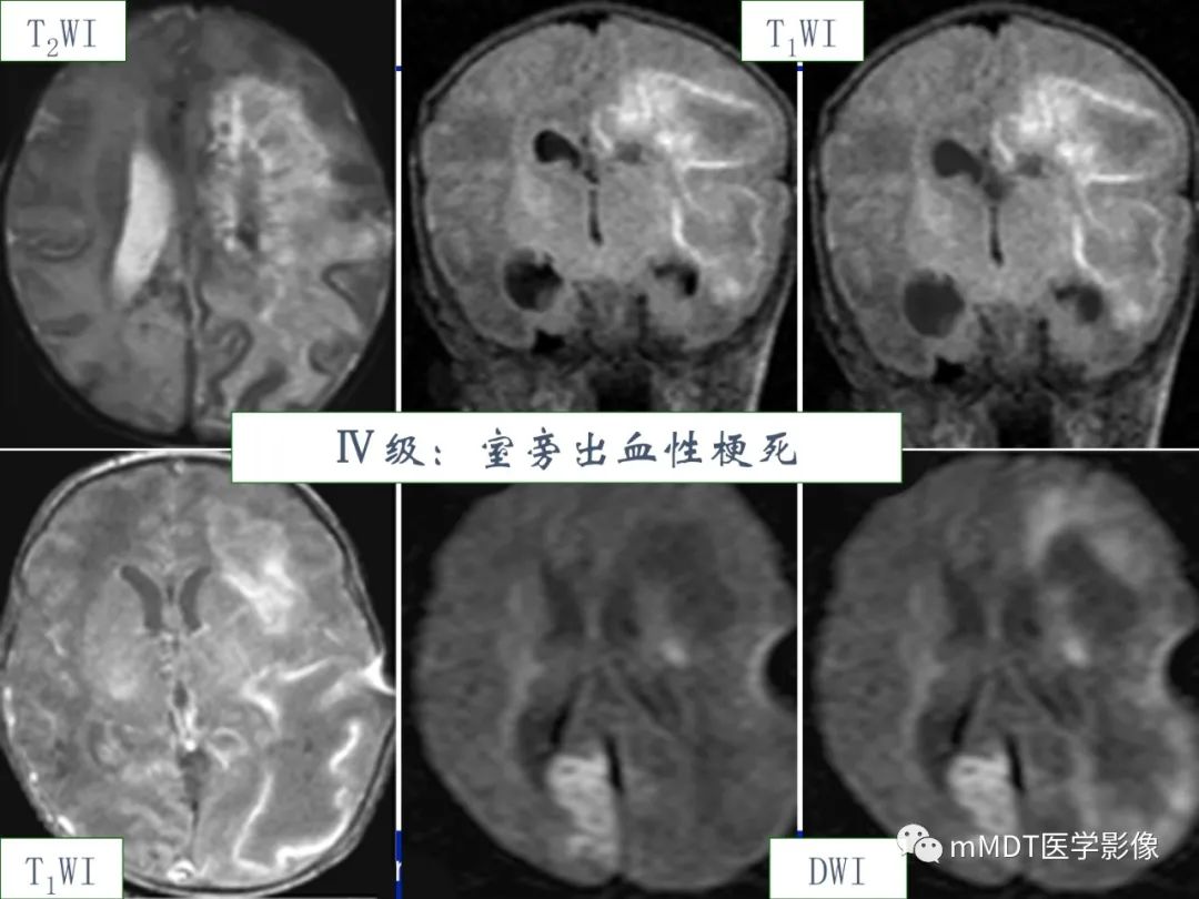 影像PPT - 【PPT】新生儿HIE影像学表现-12 影像PPT - 【PPT】新生儿HIE影像学表现-12