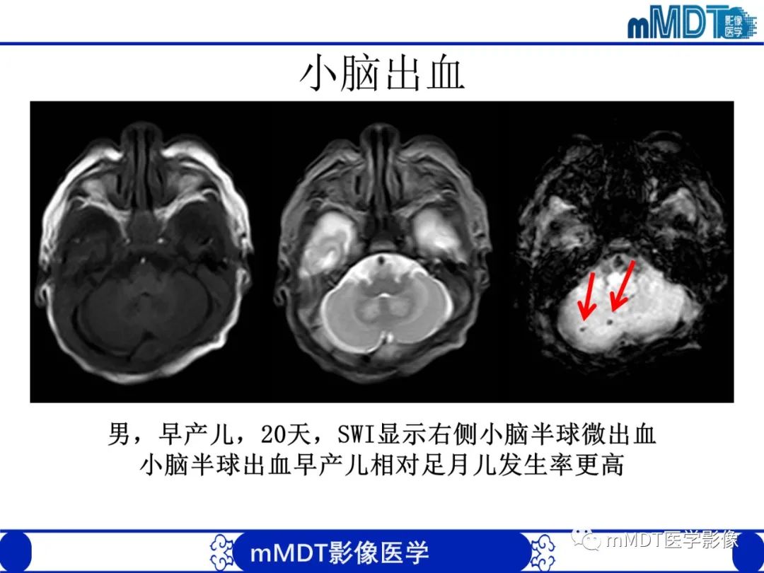 影像PPT - 【PPT】新生儿HIE影像学表现-13 影像PPT - 【PPT】新生儿HIE影像学表现-13