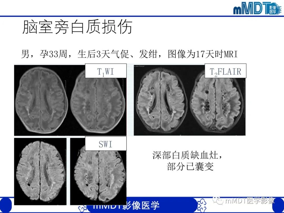 影像PPT - 【PPT】新生儿HIE影像学表现-15 影像PPT - 【PPT】新生儿HIE影像学表现-15