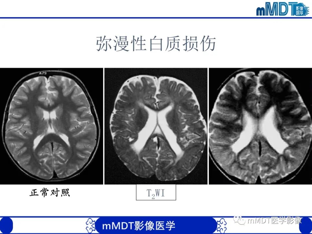 影像PPT - 【PPT】新生儿HIE影像学表现-17 影像PPT - 【PPT】新生儿HIE影像学表现-17
