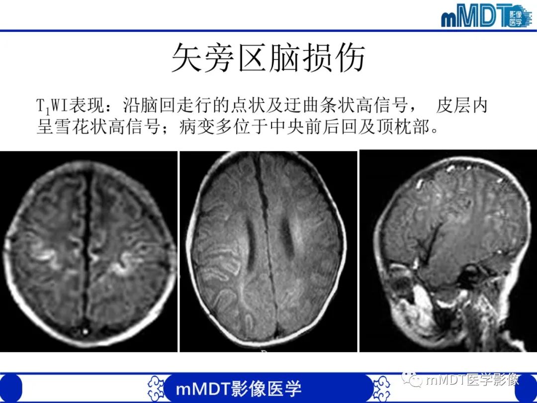 影像PPT - 【PPT】新生儿HIE影像学表现-20 影像PPT - 【PPT】新生儿HIE影像学表现-20