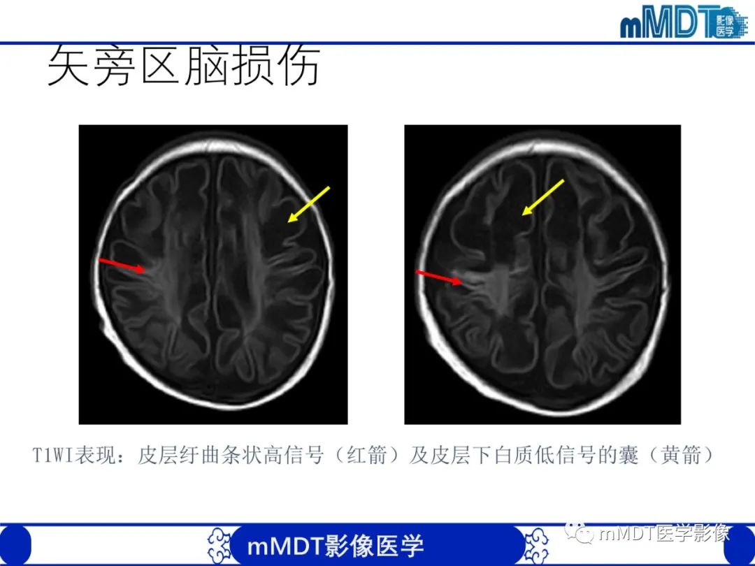 影像PPT - 【PPT】新生儿HIE影像学表现-22 影像PPT - 【PPT】新生儿HIE影像学表现-22