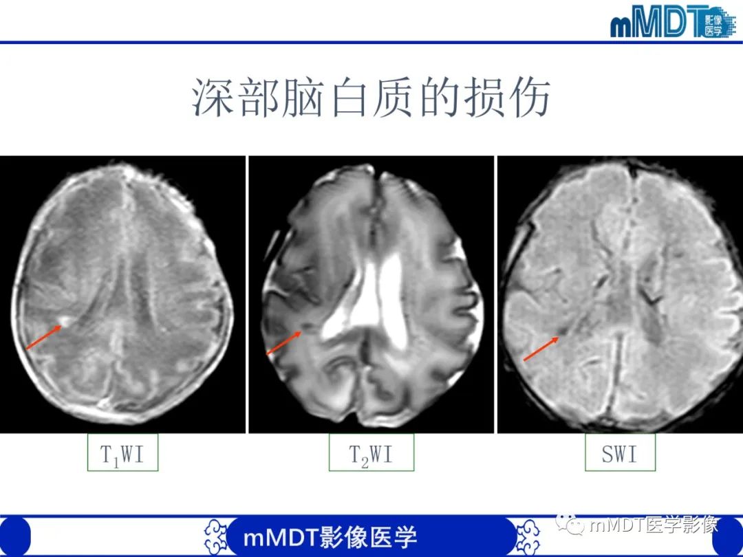 影像PPT - 【PPT】新生儿HIE影像学表现-24 影像PPT - 【PPT】新生儿HIE影像学表现-24