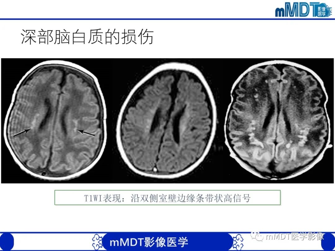 影像PPT - 【PPT】新生儿HIE影像学表现-25 影像PPT - 【PPT】新生儿HIE影像学表现-25