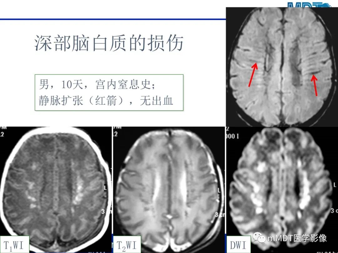 影像PPT - 【PPT】新生儿HIE影像学表现-26 影像PPT - 【PPT】新生儿HIE影像学表现-26