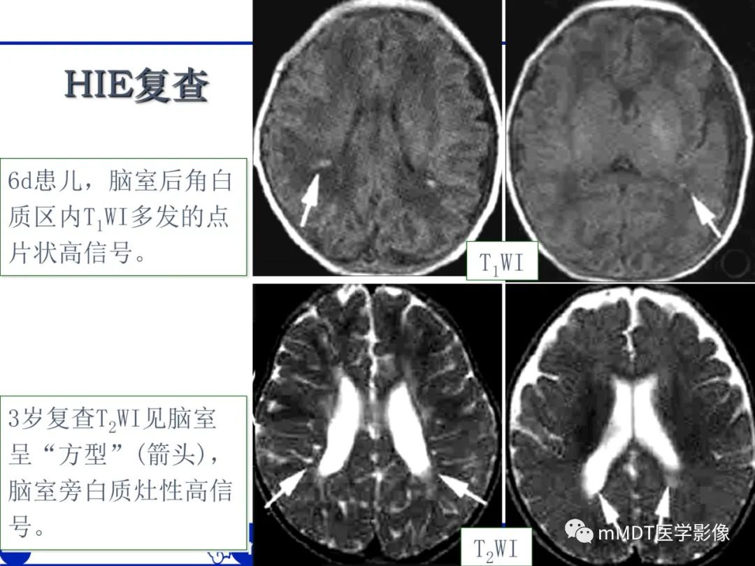 影像PPT - 【PPT】新生儿HIE影像学表现-27 影像PPT - 【PPT】新生儿HIE影像学表现-27