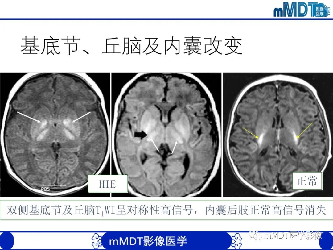 影像PPT - 【PPT】新生儿HIE影像学表现-30 影像PPT - 【PPT】新生儿HIE影像学表现-30