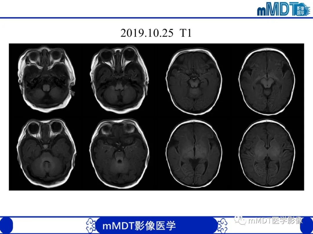 影像PPT - 【PPT】新生儿HIE影像学表现-32 影像PPT - 【PPT】新生儿HIE影像学表现-32