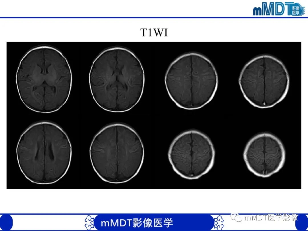影像PPT - 【PPT】新生儿HIE影像学表现-33 影像PPT - 【PPT】新生儿HIE影像学表现-33