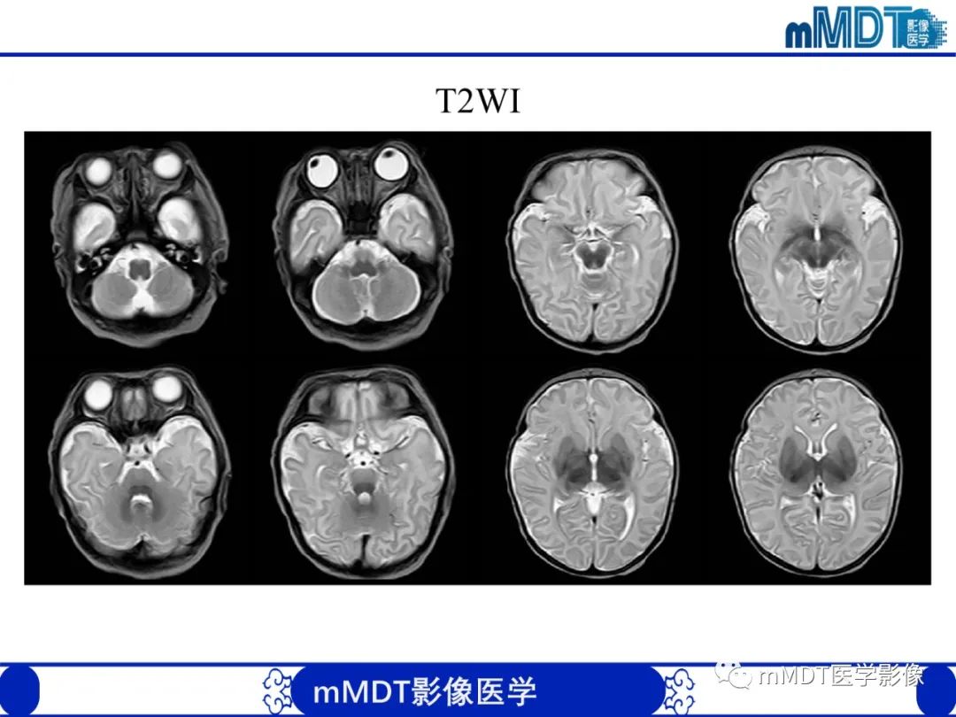 影像PPT - 【PPT】新生儿HIE影像学表现-34 影像PPT - 【PPT】新生儿HIE影像学表现-34